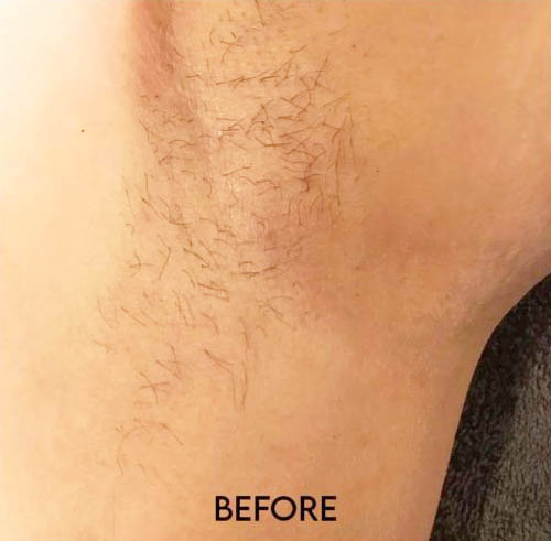 laser hair removal armit before